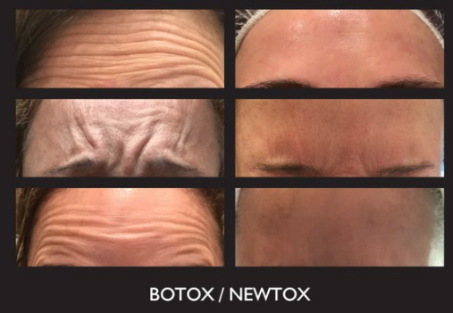 Botox Treatment Before & After