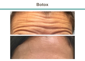 forehead with wrinkles, Botox, Flemington NJ