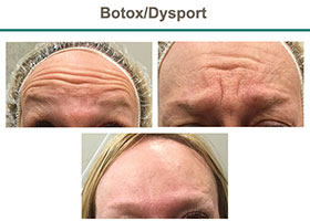 forehead with wrinkle, Botox, Flemington NJ