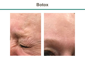 woman with eye wrinkle, Botox, Flemington NJ