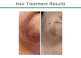 Chin with ingrown issue and after going through Laser Hair Removal, Flemington NJ