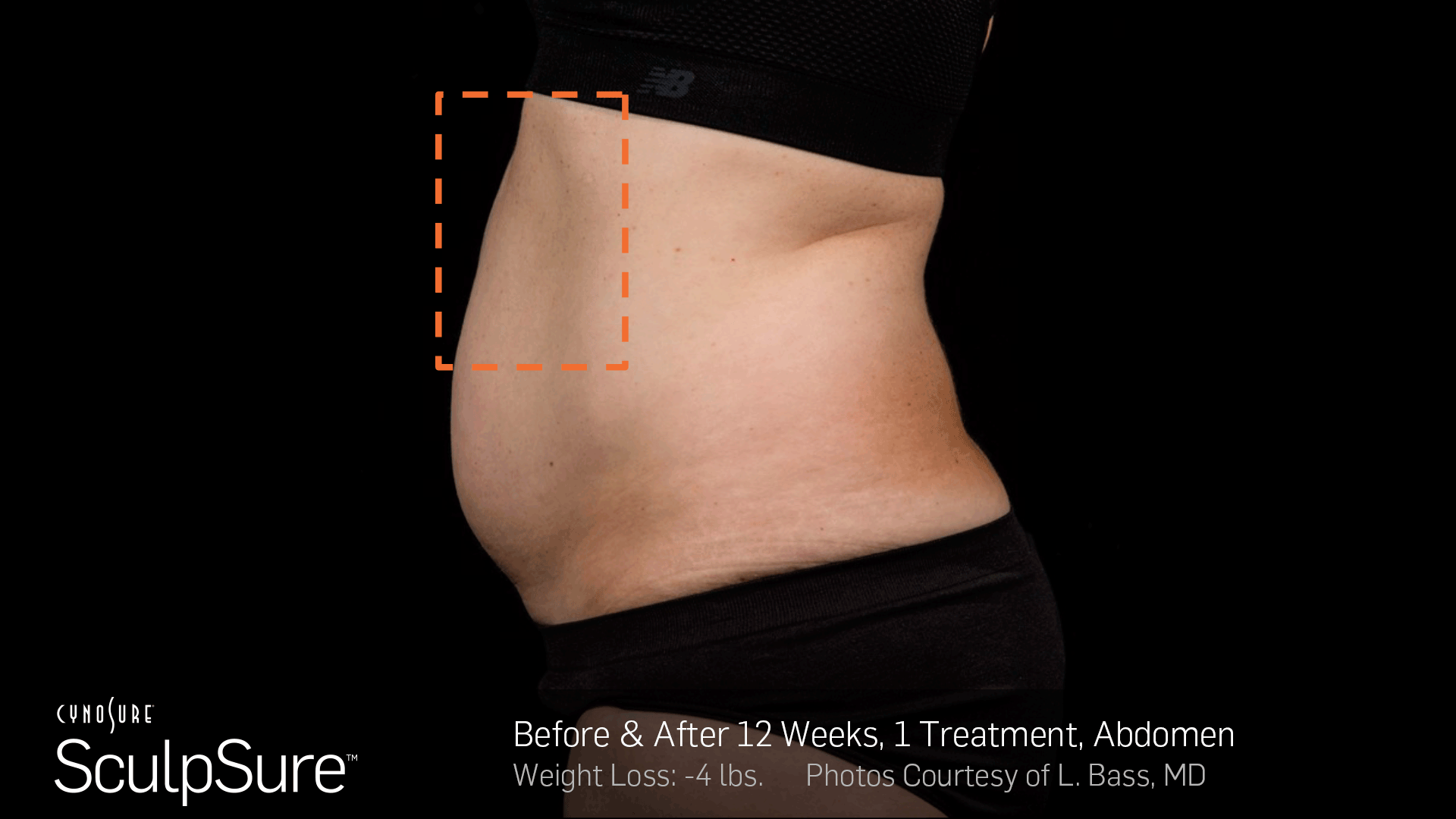 Sculpsure Before and After