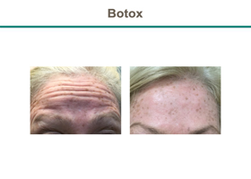 Botox Before & After Results