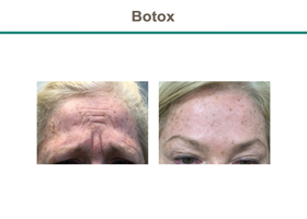 Botox Before & After Results