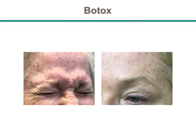 Botox Before & After Results