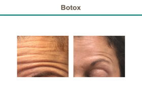 Botox Before & After Results