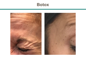 Botox Before & After Results