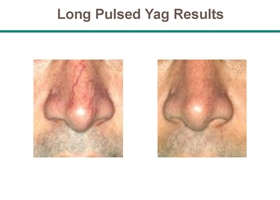 Facial/Spider Veins