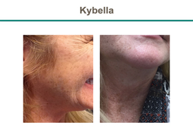 Kybella