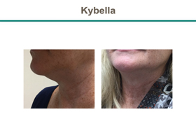 Kybella