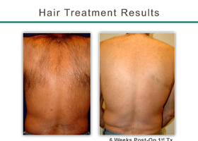 Laser Hair Removal Before & After Flemington