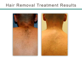 Laser Hair Removal Before & After Flemington