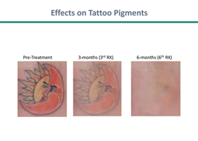 Laser Tattoo Removal