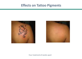 Laser Tattoo Removal