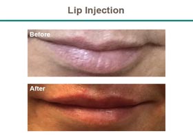 Lip Injection Before & After Flemington