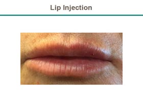 Lip Injection Before & After Flemington