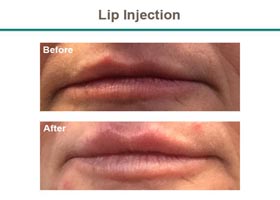 Lip Injection Before & After Flemington
