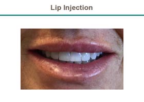 Lip Injection Before & After Flemington