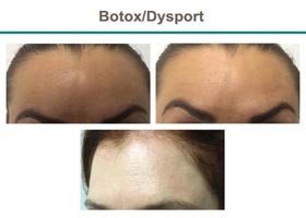 Botox/Dysport Before & After Results