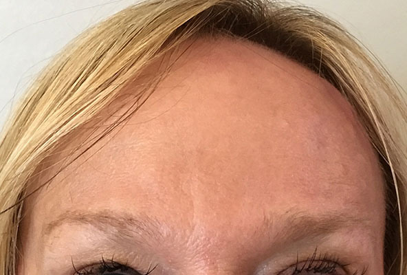 Forehead Treated With Botox