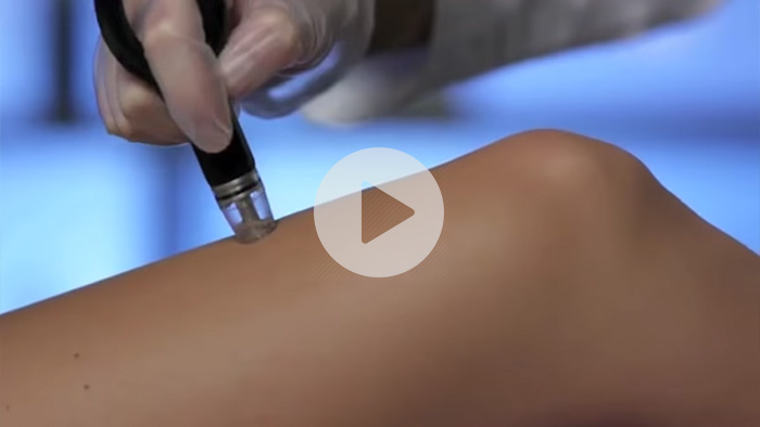 Laser Skin Revitalization by Cynosure