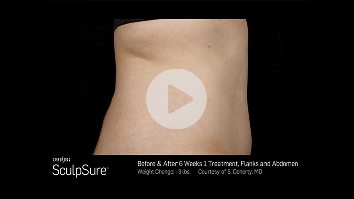 Silkpeel Before and After - Sculpsure