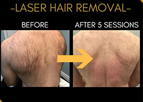 Laser Hair Removal Before & After Flemington