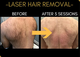 Laser Hair Removal