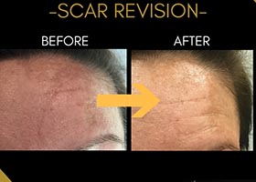 Scar Revision