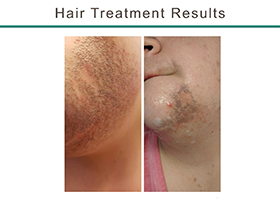 Laser Hair Removal