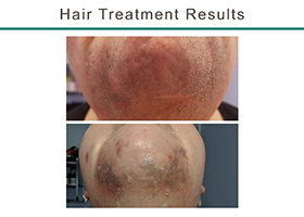 Laser Hair Removal Before & After Flemington