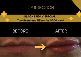 Lip Injection