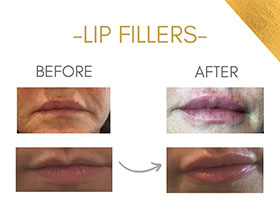 Lip Fillers