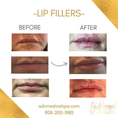 Lip Fillers Before & After Flemington
