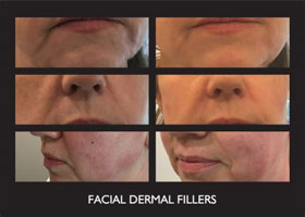 Facial Fillers Before & After Flemington