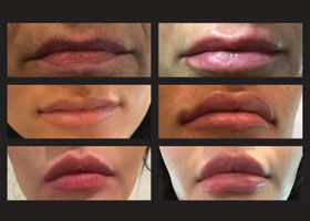 Lip Filler Before & After Flemington
