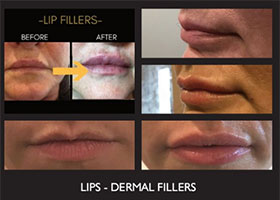 Lip Injection Before & After Flemington