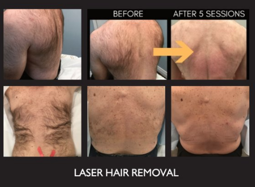 Laser Hair Removal before & after results