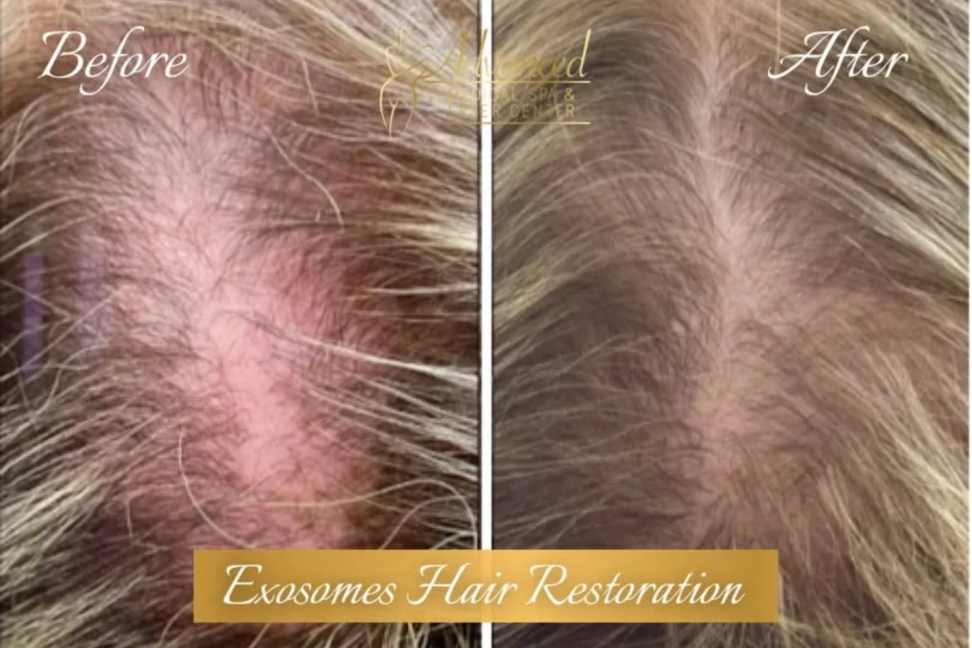 Exosomes hair treatment before and after scalp comparison