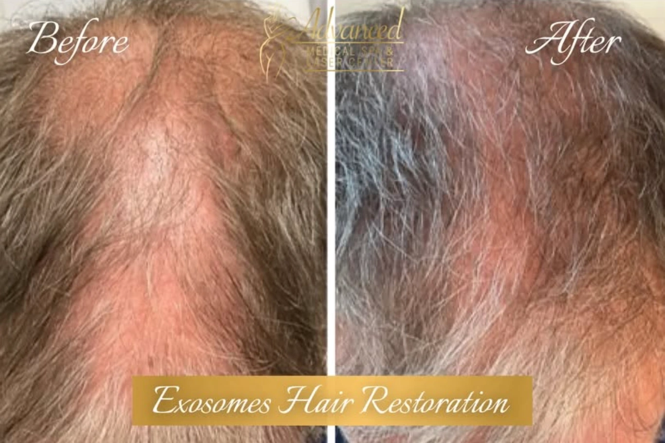 Exosome therapy for hair loss before and after treatment