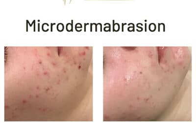 Experience the Next Generation of Microdermabrasion