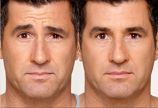 botox before and after photo by advanced medical spa laser center in flemington nj