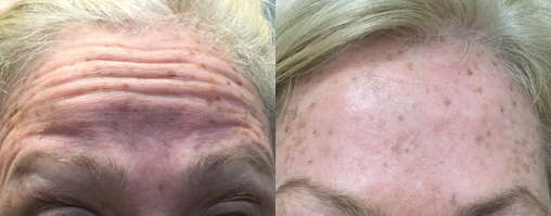 botox before and after photo by advanced medical spa laser center in flemington nj