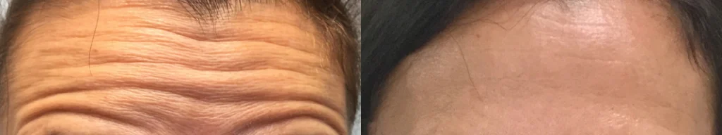 botox before and after photo by advanced medical spa laser center in flemington nj
