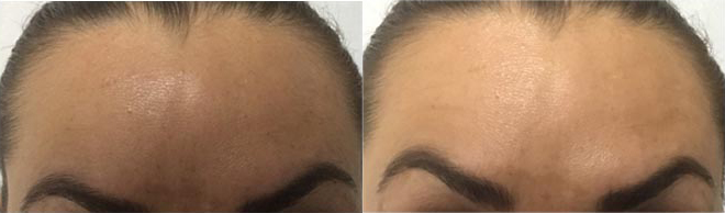 botox before and after photo by advanced medical spa laser center in flemington nj