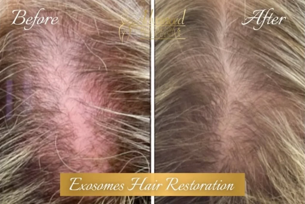 exosomes hair restoration before and after photo by advanced medical spa laser center in flemington nj