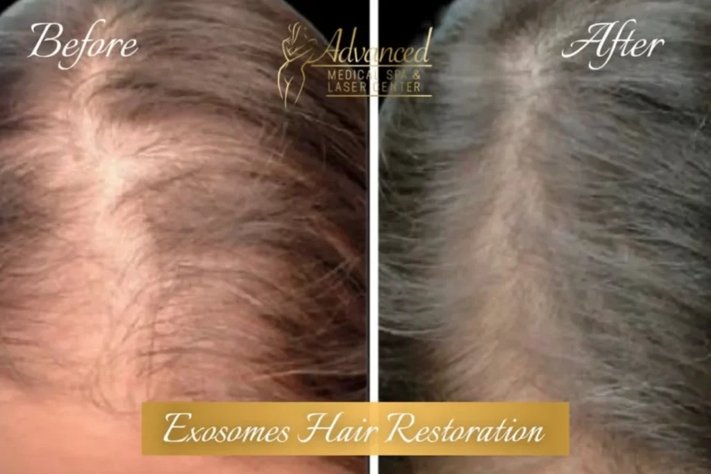 exosomes hair restoration before and after photo by advanced medical spa laser center in flemington nj