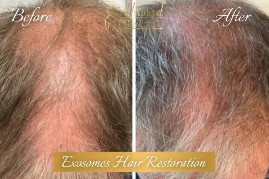 exosomes hair restoration before and after photo by advanced medical spa laser center in flemington nj