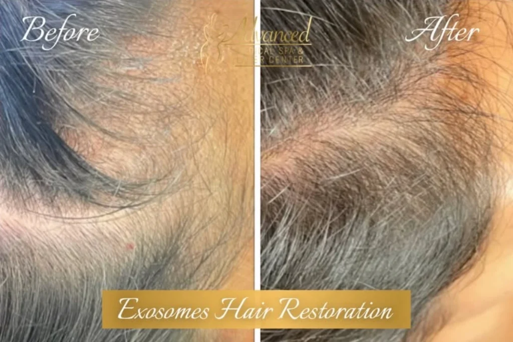 exosomes hair restoration before and after photo by advanced medical spa laser center in flemington nj