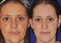 microneedling before and after photo by advanced medical spa laser center in flemington nj